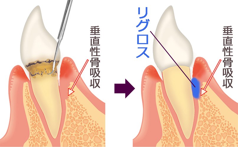リグロス法で歯周組織再生療法