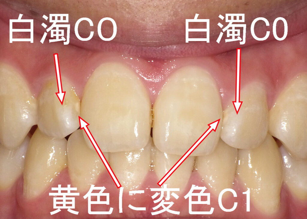 歯の表面に白濁した初期虫歯CO