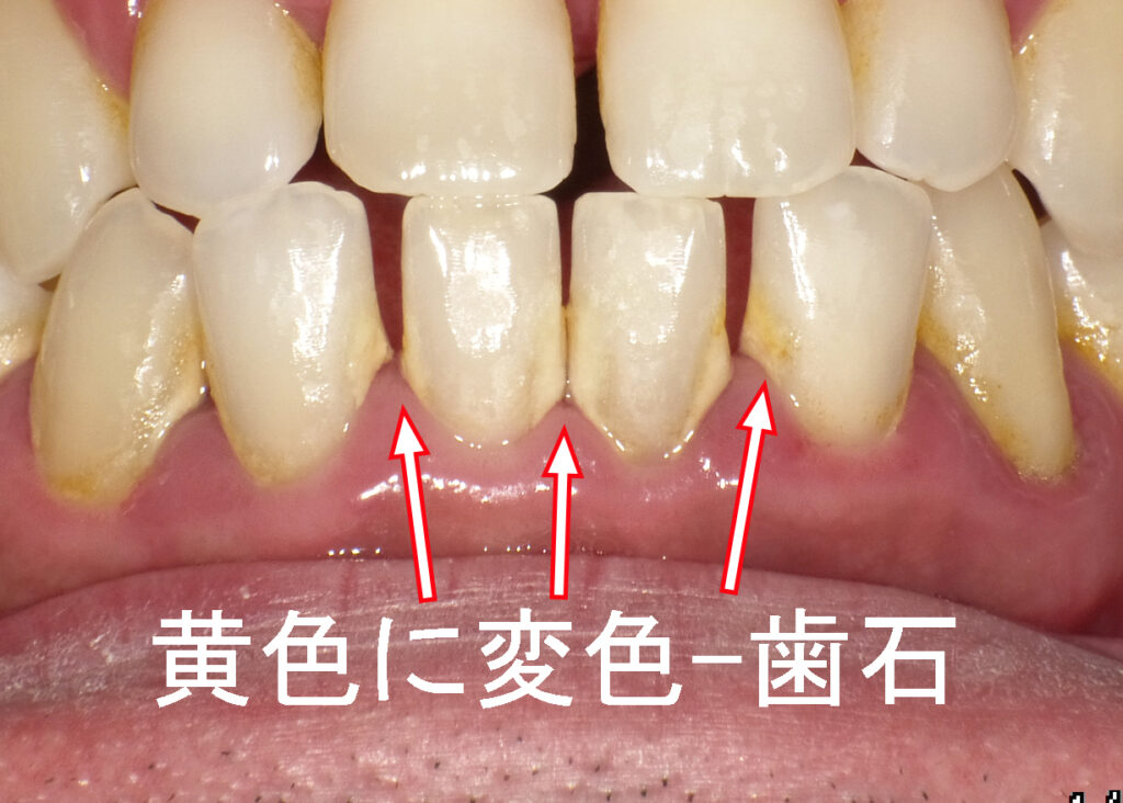 多数歯の根元が黄色に変色ー歯石
