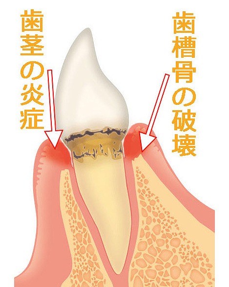 歯周病