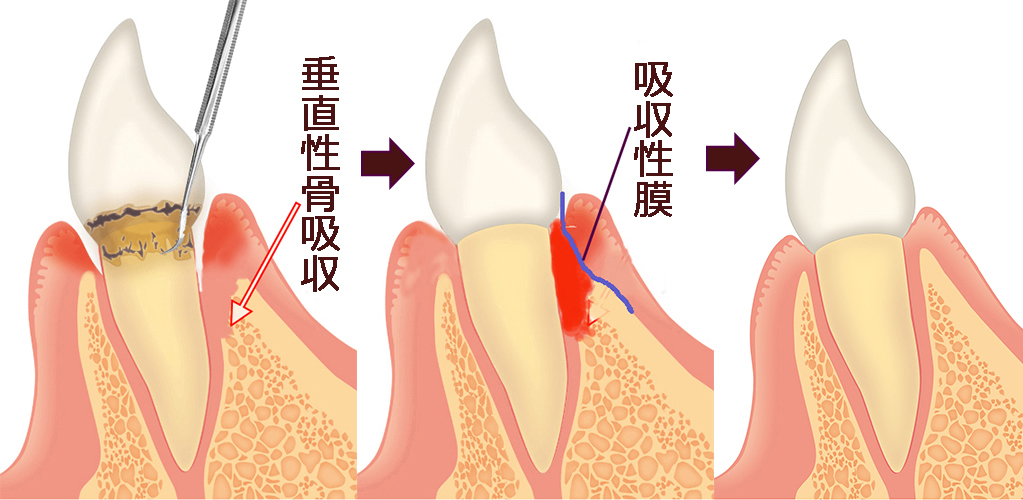 GTR法(歯周組織再生誘導法)
