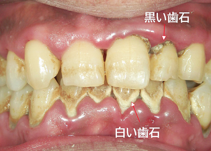 歯石