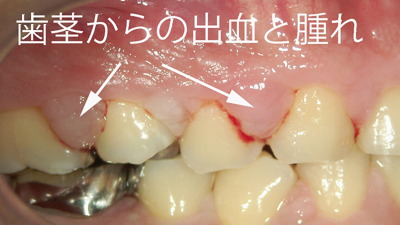 高血圧症+カルシウム拮抗薬の服用