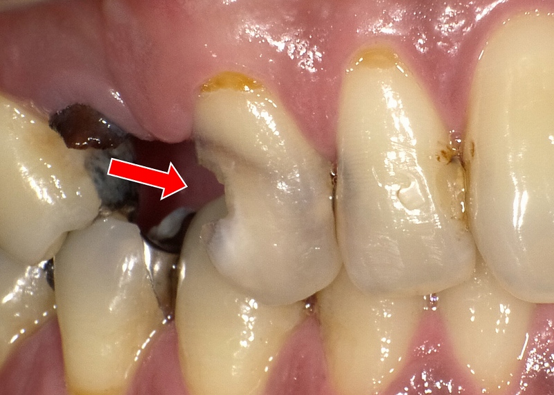 犬歯の虫歯C3