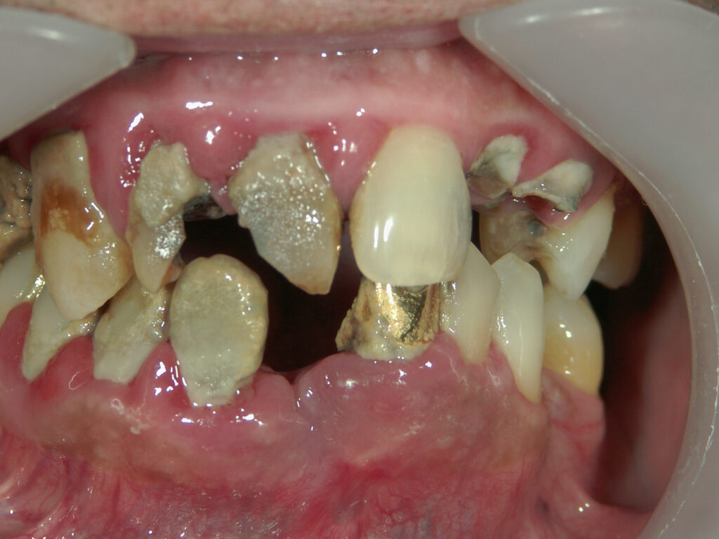 虫歯を10年以上放置した症例 正面