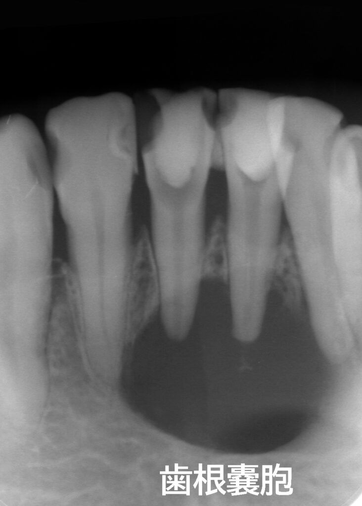 下顎第中切歯の歯根嚢胞