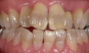 薬害テトラサイクリン歯の治し方