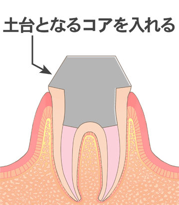 土台(コア)の作成・装着