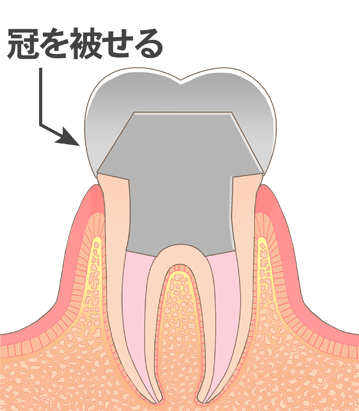 クラウン(冠)装着