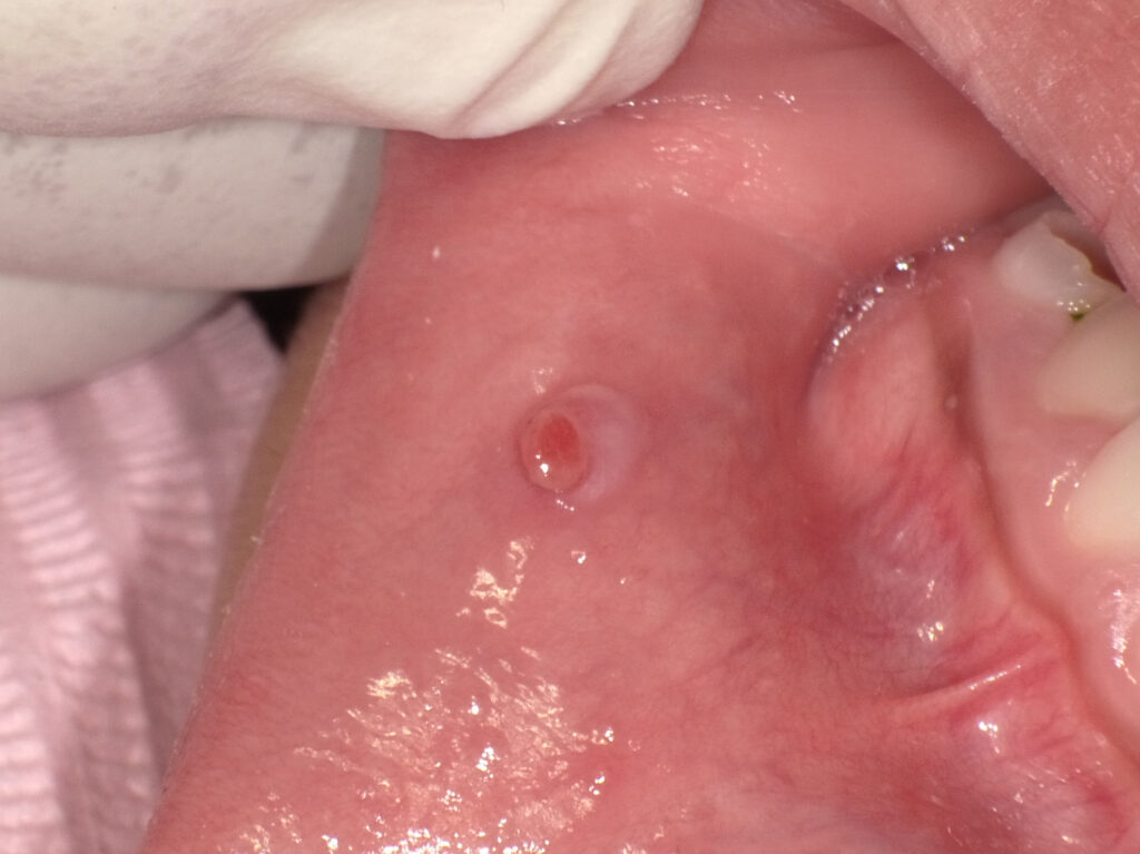 下唇に出来た直径5mm程の粘液嚢胞