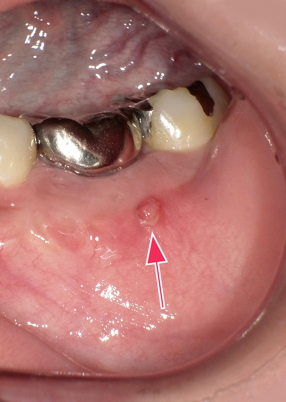 下顎第一大臼歯のフィステル
