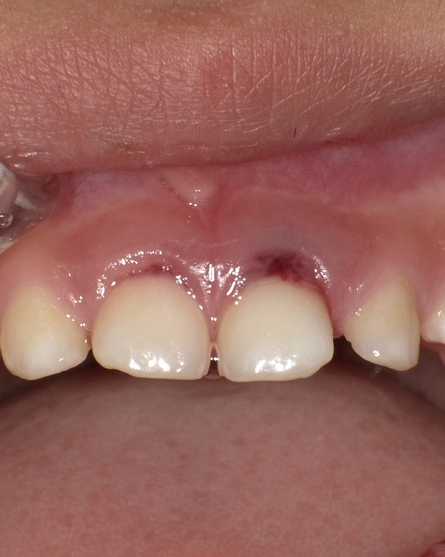 5歳児が顔面を強打し歯茎が黒く変色