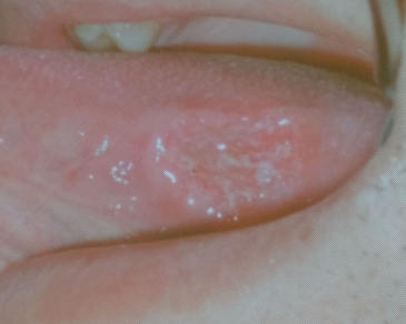 初期舌癌-潰瘍型