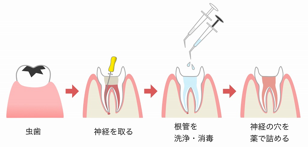 歯の神経を抜く治療