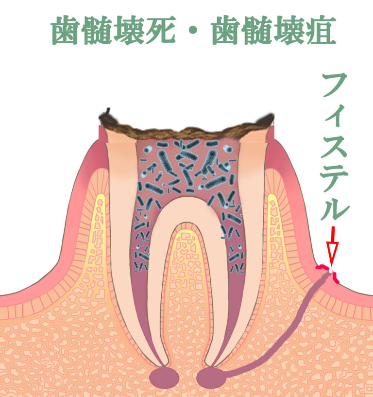 歯髄壊疽