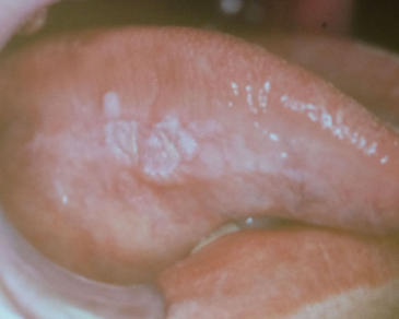 初期舌癌-白板型
