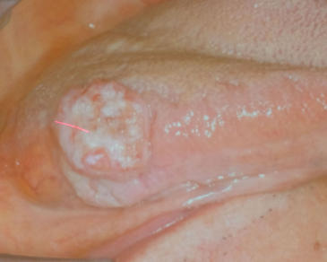 初期舌癌-肉芽型