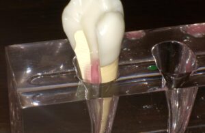 歯髄再生治療