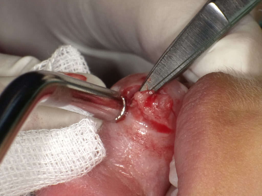 外科用歯肉ハサミで深部の小唾液腺を切除