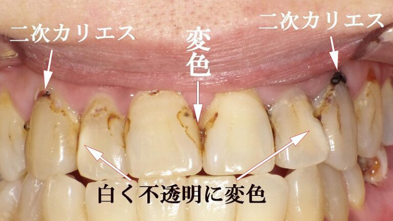 コンポジットレジン充填部に発生する二次カリエス