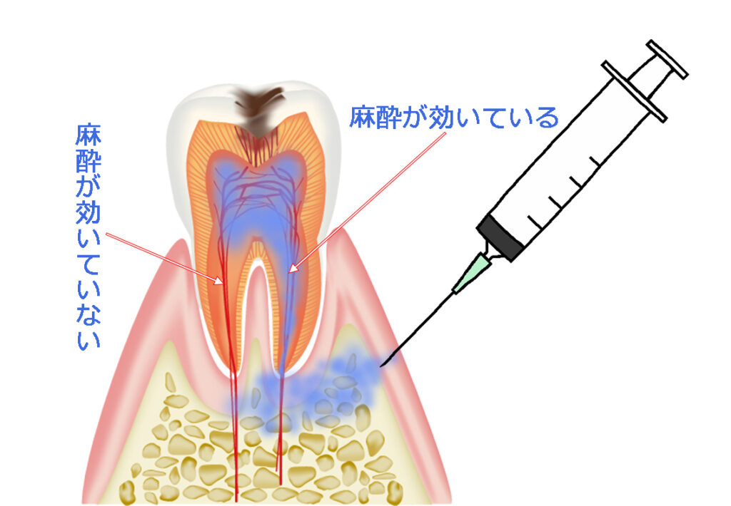 浸潤麻酔とは？痛みを最小限にする歯科麻酔の工夫と最新技術