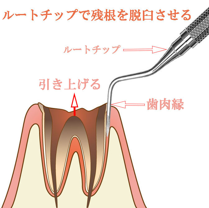 外科的挺出法