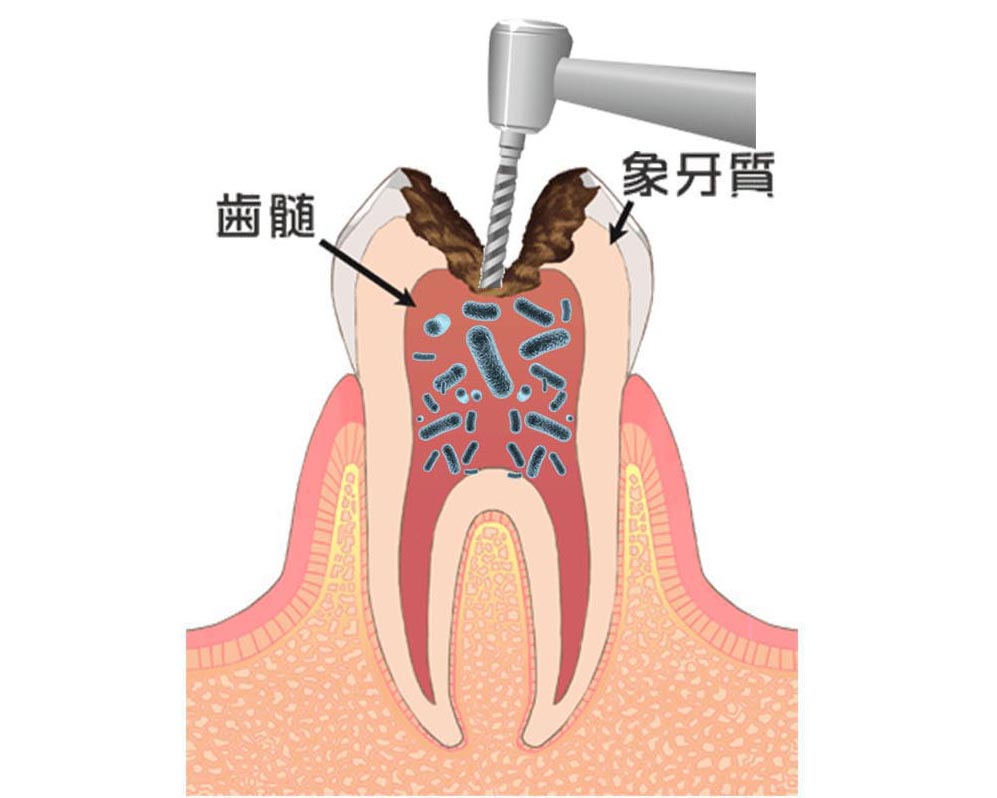 虫歯除去と歯髄除去(抜髄)