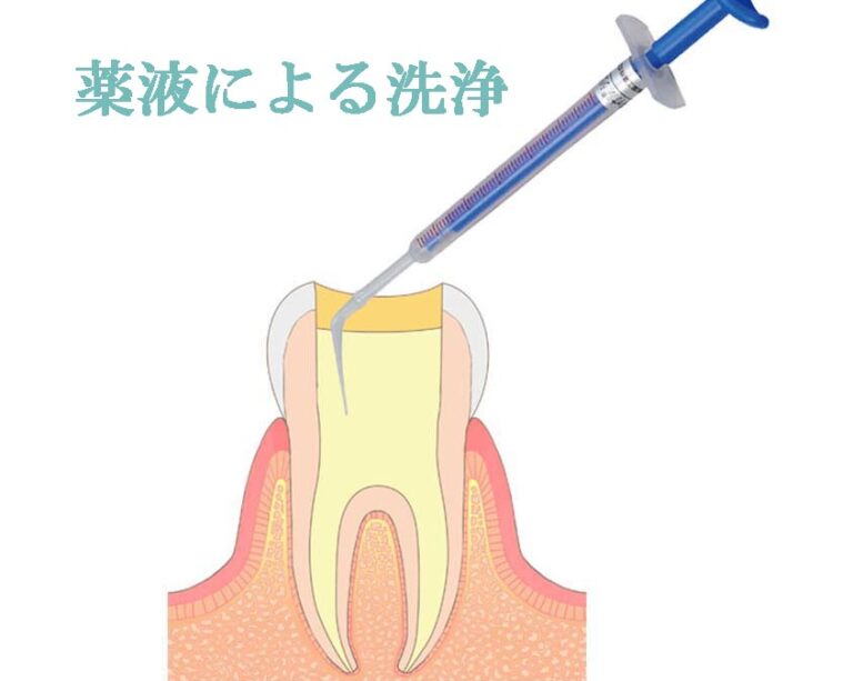 根管内の洗浄・消毒・貼薬
