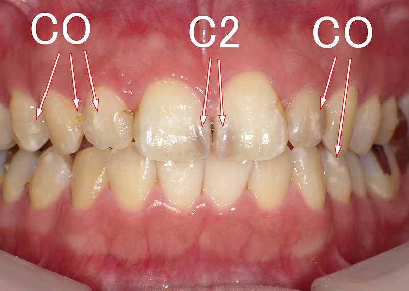 穴が空いていない虫歯C2　症例1