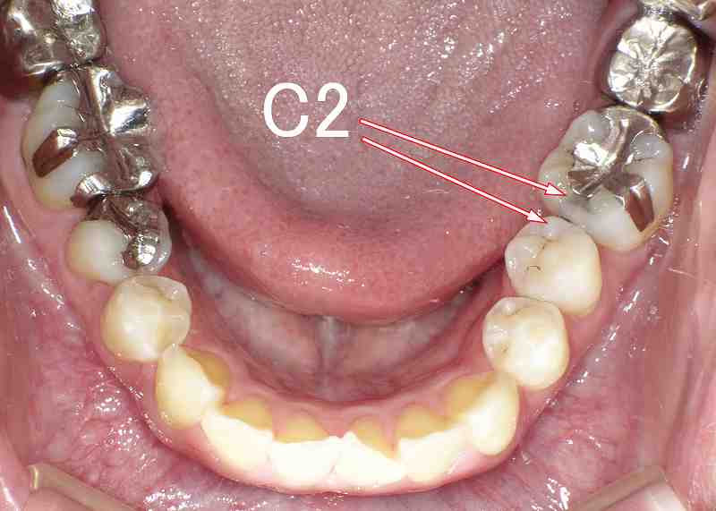 穴が空いていない虫歯C2　症例2