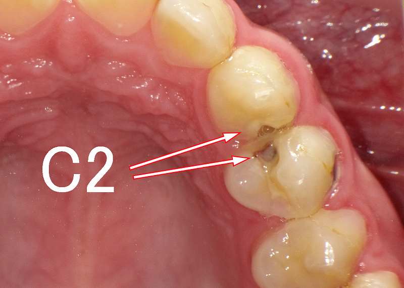 穴が空いている虫歯C2　症例1