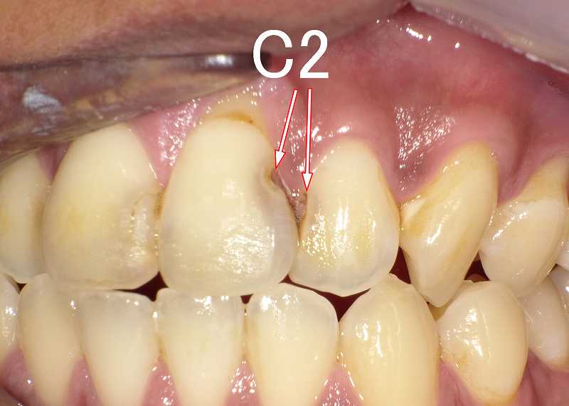 穴が空いている虫歯C2　症例2