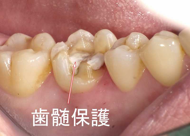 歯髄保護