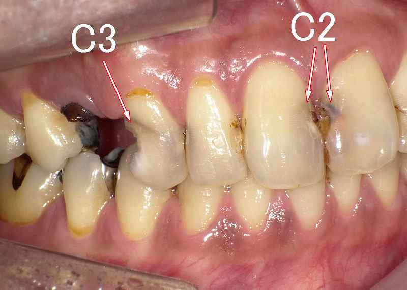 虫歯C3 症例1