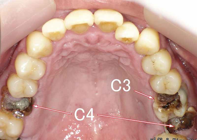 虫歯C3 症例2