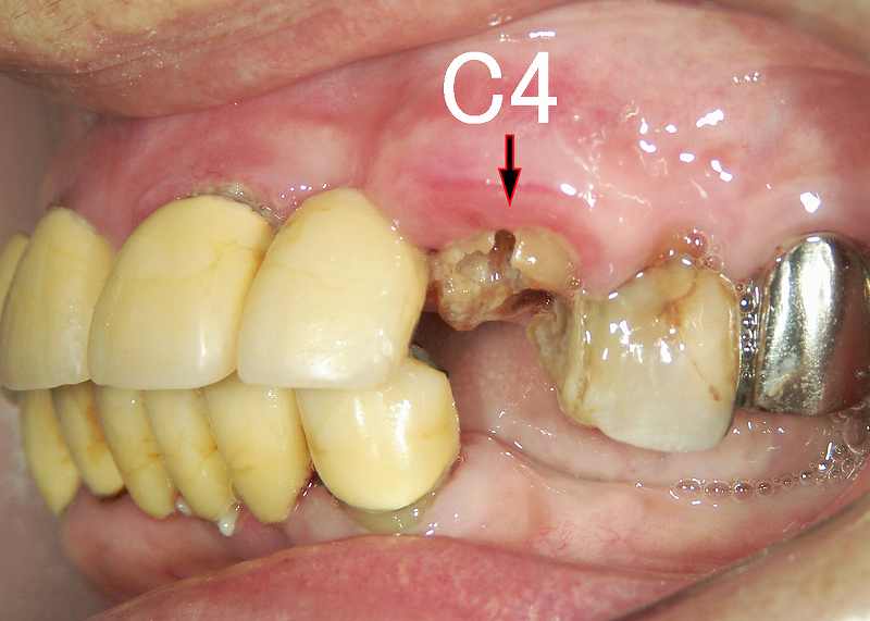 残根(虫歯C4)　症例1