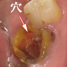 虫歯の進行度C4の症例