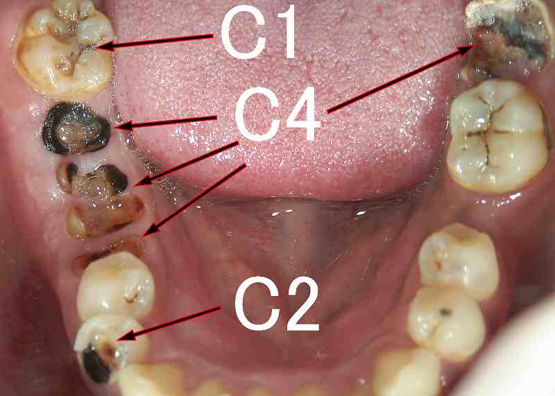 残根(虫歯C4)　症例2