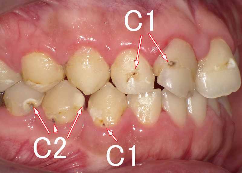 虫歯C1の見た目 症例1