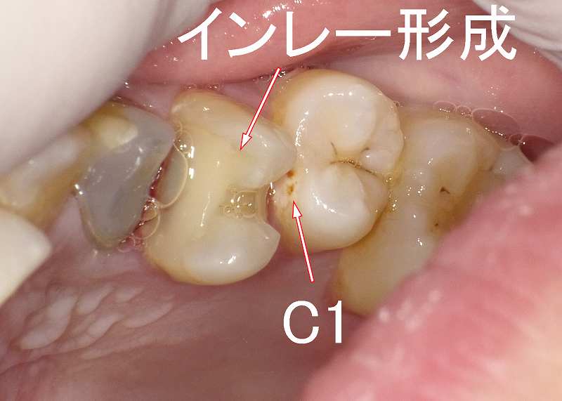 虫歯C1の見た目 症例2