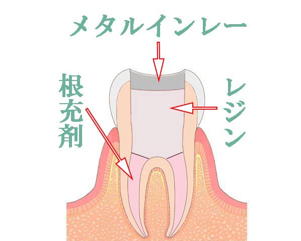メタルインレー装着