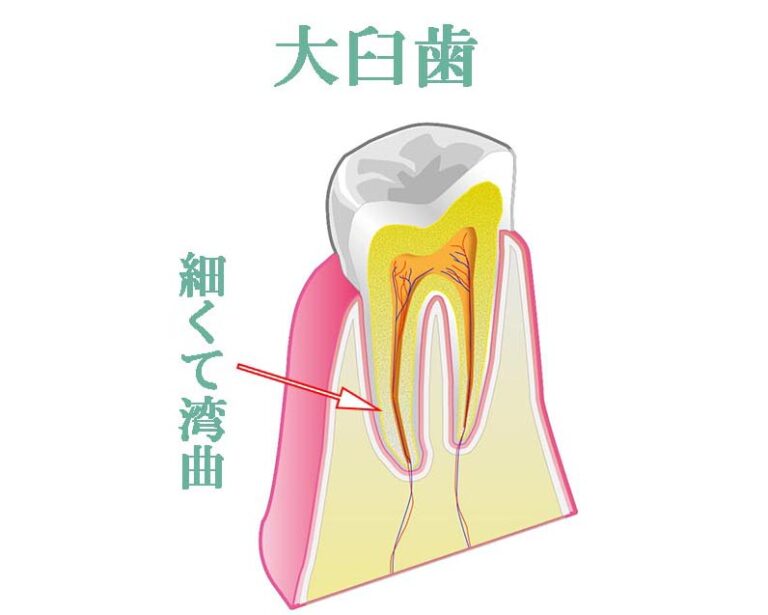 【奥歯(大臼歯)】治療が難しい