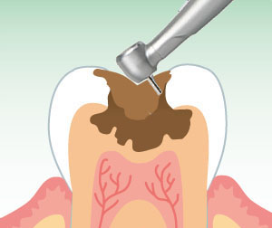歯の神経を残す治療法