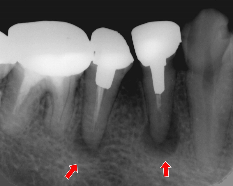 小臼歯の中程度の歯根嚢胞