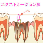 虫歯C4の残根を抜歯せず残す方法