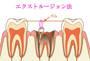 虫歯C4の残根を抜歯せず残す方法