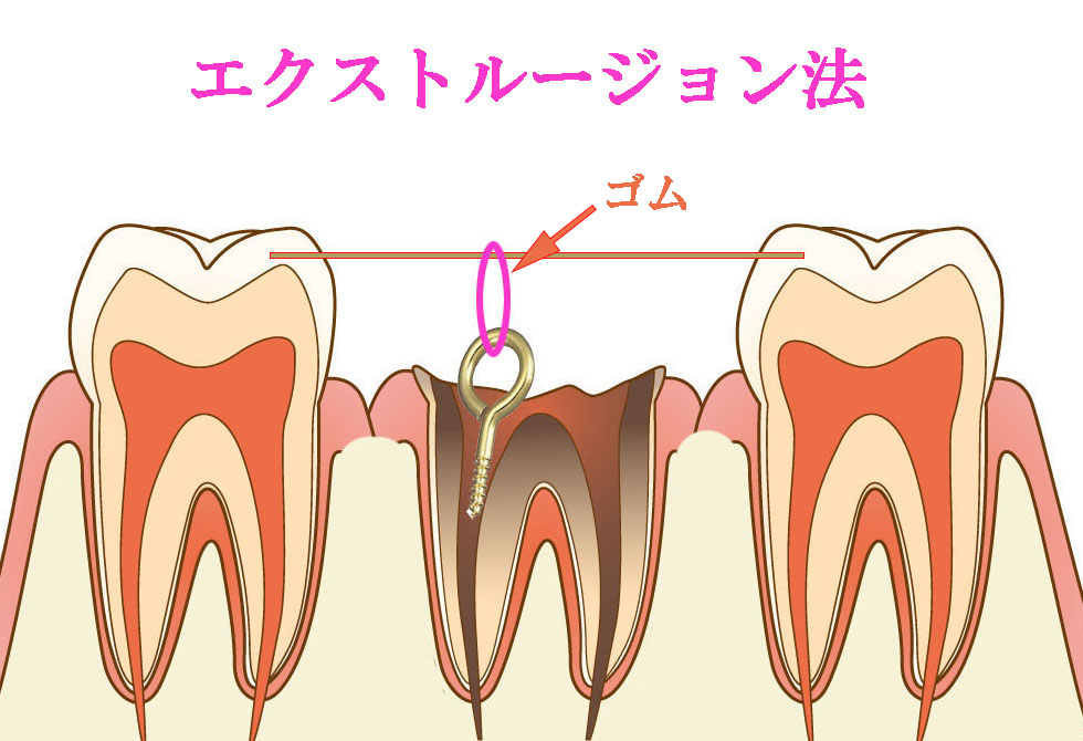 エクストルージョン法