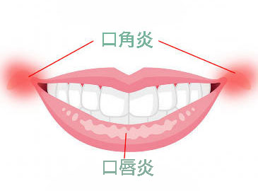 口角炎・口唇炎とは？原因・症状・治療・予防まで徹底解説！