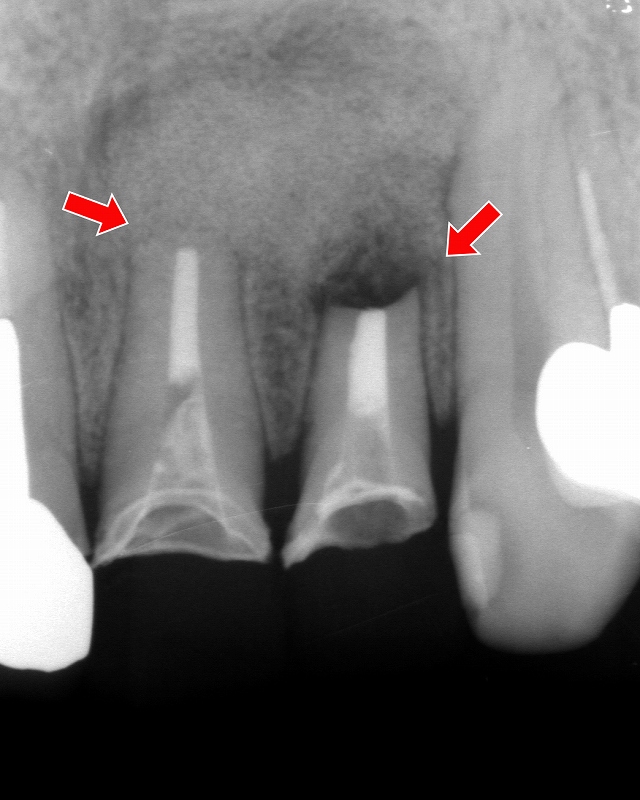 歯根嚢胞摘出手術と歯根端切除術