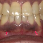 黒い歯茎を治す方法